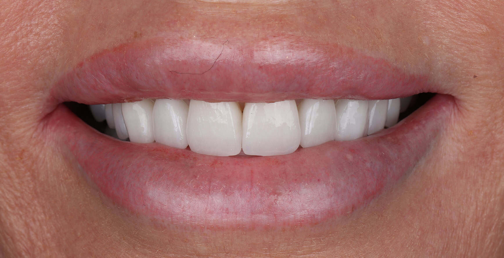 After Close-up of a bright, healthy dental smile with white teeth.
